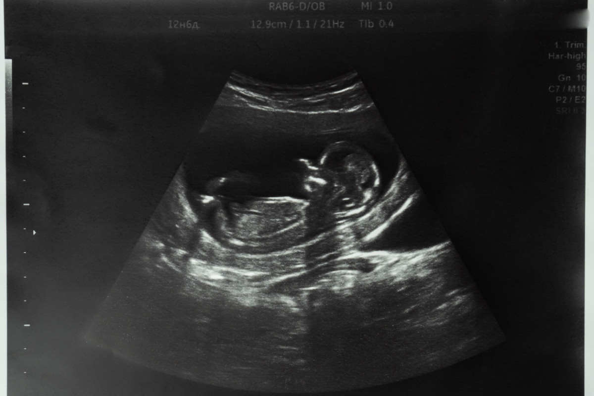 Scotland sees record high in abortion numbers amid debate over home abortion access